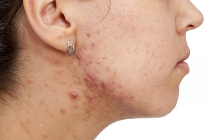 Perioral Dermatitis - American Osteopathic College of ...